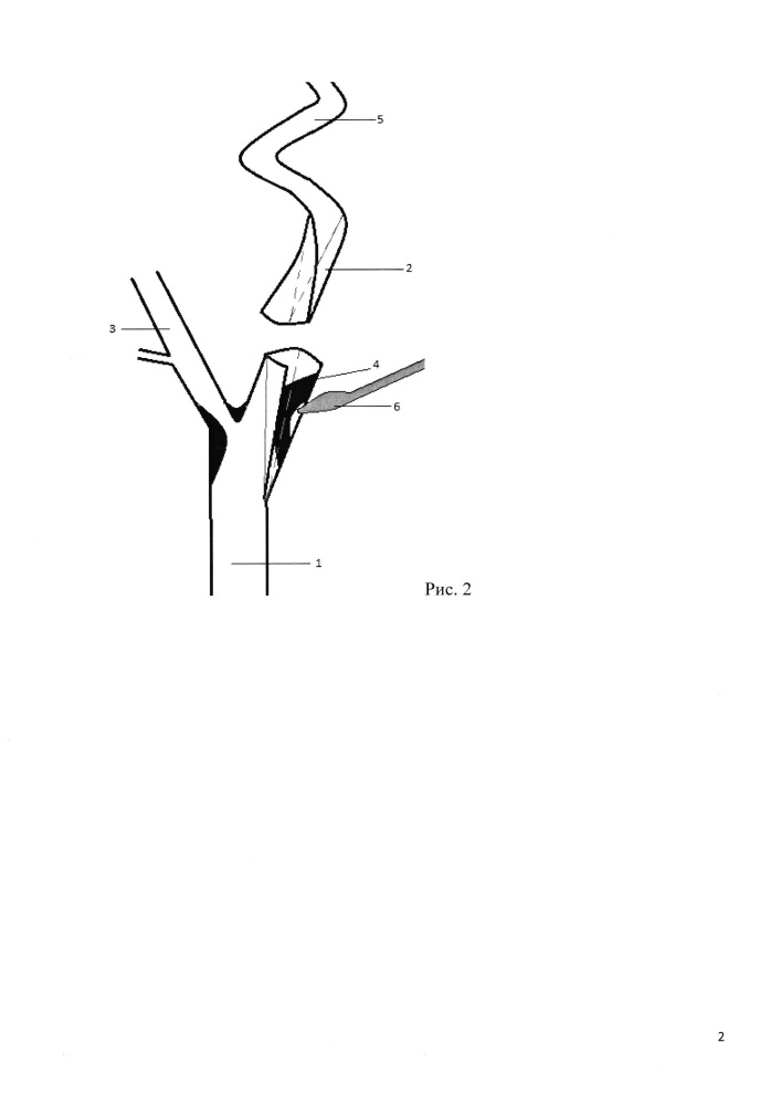 Способ лечения патологической извитости внутренней сонной артерии (патент 2654684)
