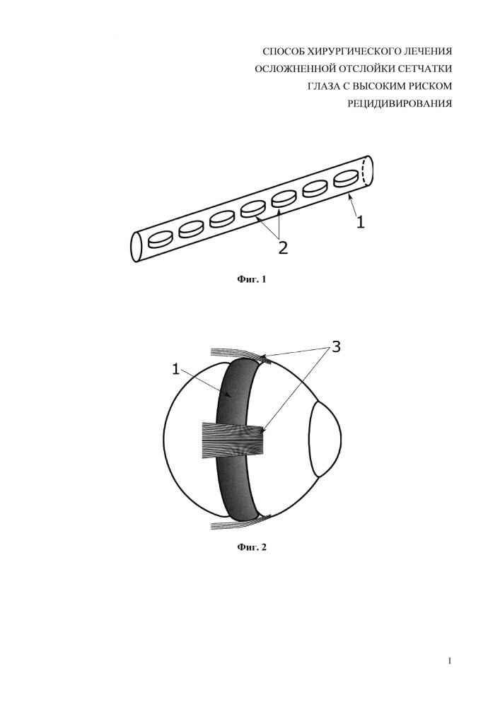 Способ хирургического лечения осложненной отслойки сетчатки глаза с высоким риском рецидивирования (патент 2628651)