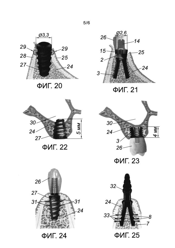 Зубной имплантат и комплект для дентальной имплантации (патент 2661019)