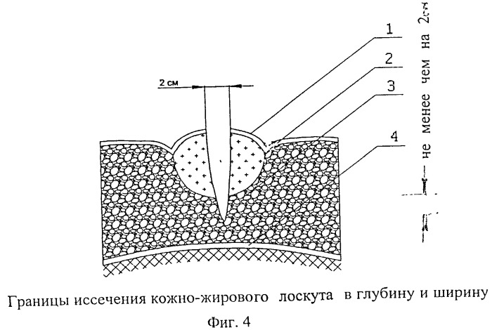 Одноэтапный метод хирургического лечения эпителиального копчикового хода (патент 2499562)