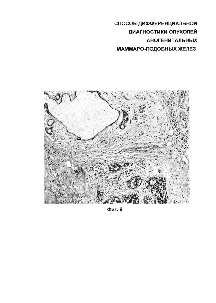Способ дифференциальной диагностики опухолей аногенитальных маммароподобных желез (патент 2626123)