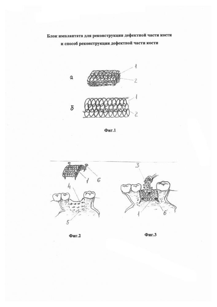 Блок имплантата для реконструкции дефектной части кости и способ реконструкции дефектной части кости (патент 2620494)