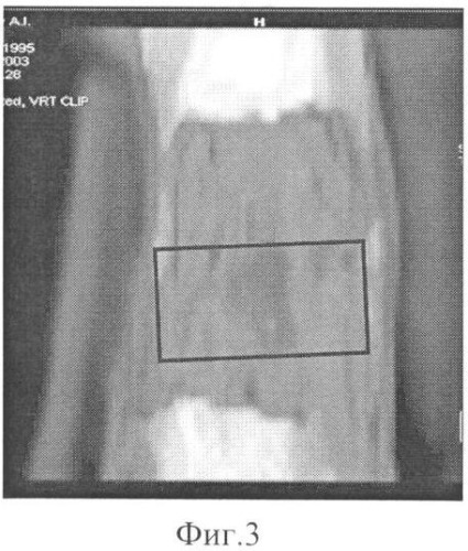 Способ прогнозирования перестройки дистракционного регенерата методом компьютерной томографии (патент 2342904)