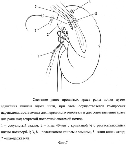 Способ ушивания раны почки при лапароскопическом органосохраняющем лечении рака почки в условиях тепловой ишемии (патент 2532897)