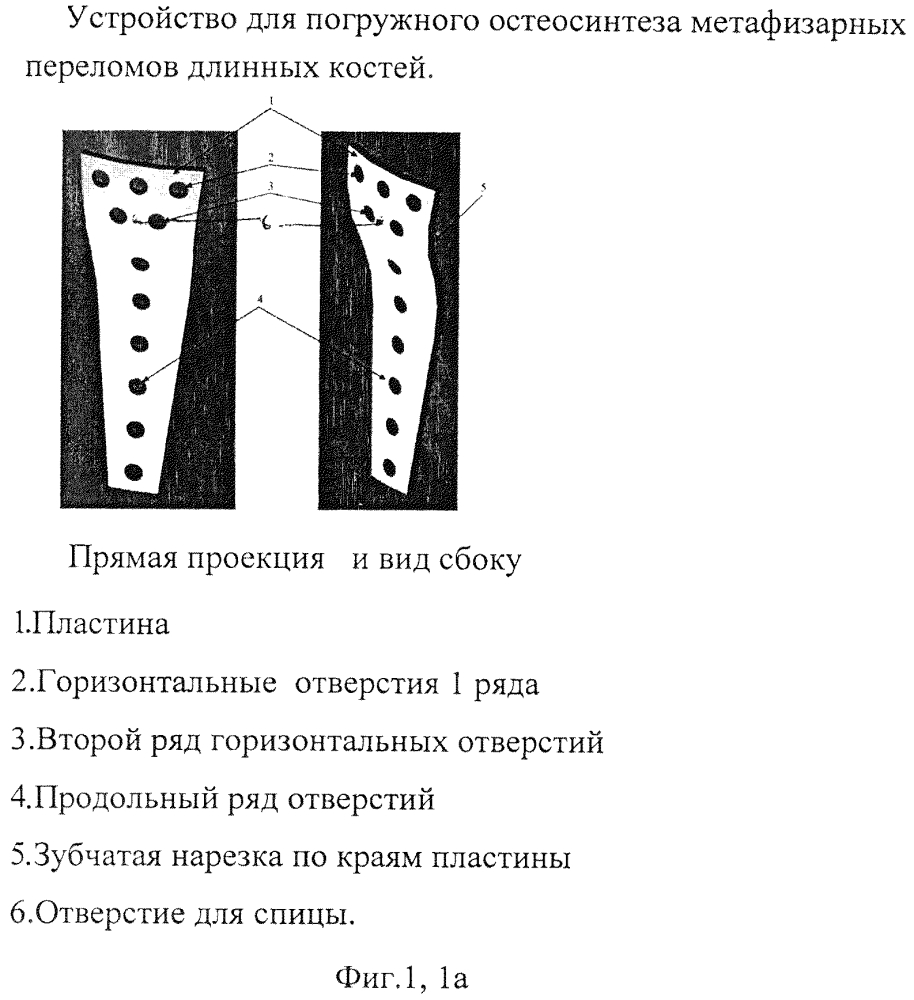 Устройство и способ блокируемого погружного остеосинтеза мыщелковых переломов длинных костей (патент 2632508)