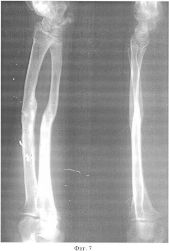 Способ чрескостного остеосинтеза диафизарных повреждений костей предплечья и аппарат для его осуществления (патент 2328242)