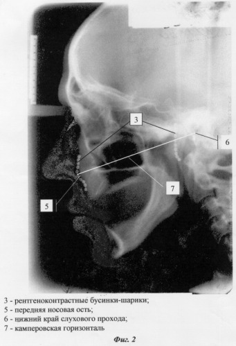 Способ определения проекции камперовской горизонтали на лице пациента (патент 2283620)