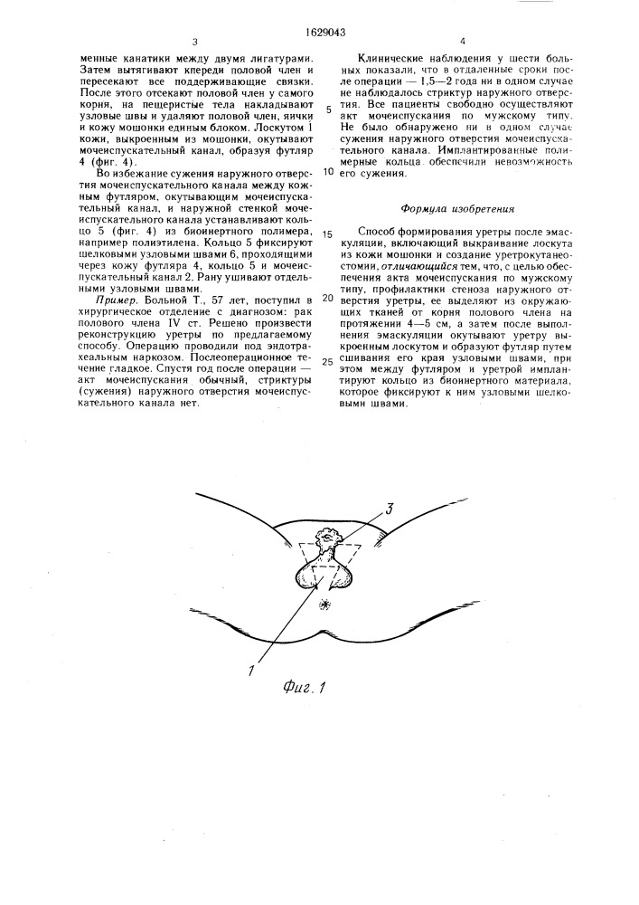 Способ формирования уретры после эмаскуляции (патент 1629043)