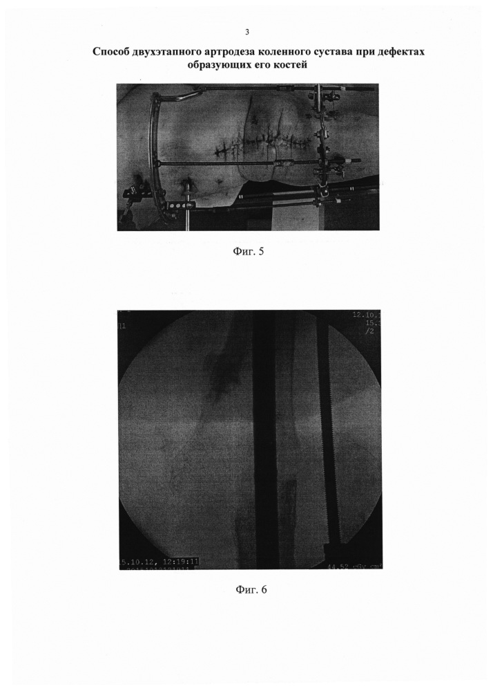Способ двухэтапного артродеза коленного сустава при дефектах образующих его костей (патент 2648863)