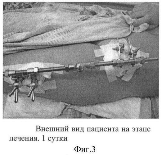 Способ лечения юношеского эпифизиолиза головки бедренной кости у детей (патент 2422110)