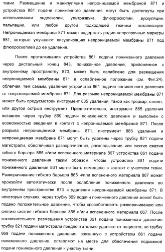 Устройство для лечения путем подкожной подачи пониженного давления с использованием разделения с помощью воздушного баллона (патент 2401652)