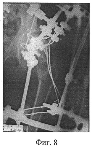 Способ лечения деформаций проксимального отдела бедра (патент 2528964)