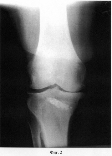 Способ хирургического лечения остеоартроза коленного сустава (патент 2477095)
