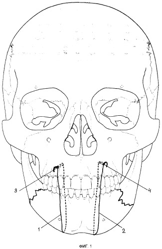 Способ иммобилизации отломков при переломах челюстей (патент 2269318)