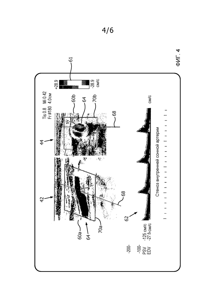 Автоматизированная последовательность операций в двухплоскостном режиме pw для ультразвуковой оценки стеноза (патент 2633915)