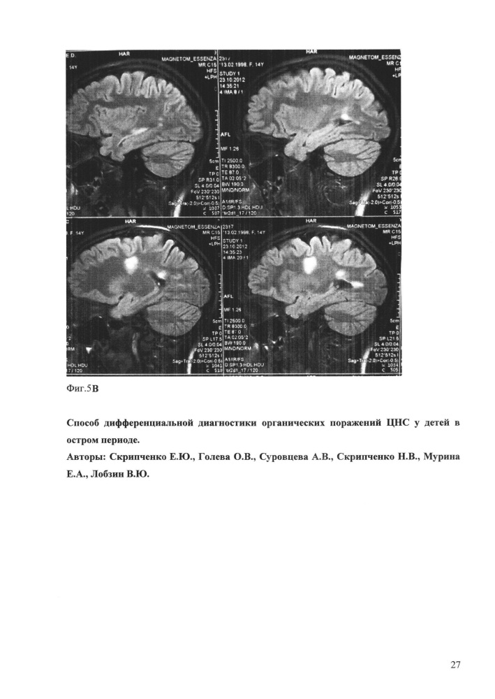 Способ дифференциальной диагностики органических поражений цнс у детей в остром периоде (патент 2648215)