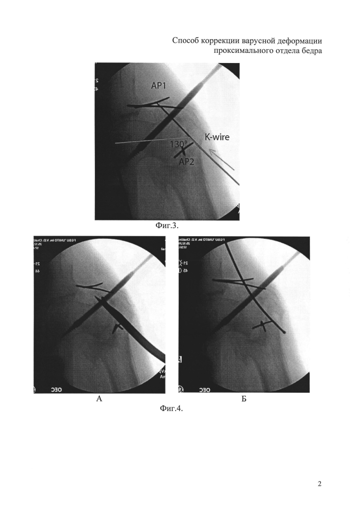 Способ коррекции варусной деформации проксимального отдела бедра (патент 2598759)