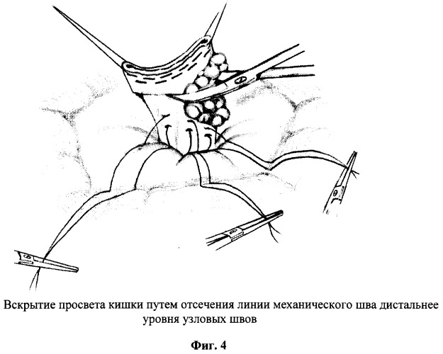Способ восстановления сосудистого механизма держания при формировании искусственного заднего прохода (патент 2292846)