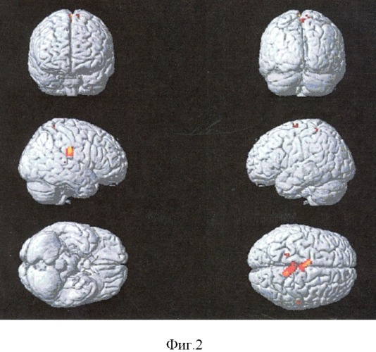 Способ нейровизуализации зон активации головного мозга, ответственных за ходьбу (патент 2428931)