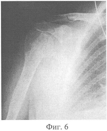 Способ хирургического лечения оскольчатых переломов проксимального отдела плечевой кости напряженными спицами (патент 2357692)