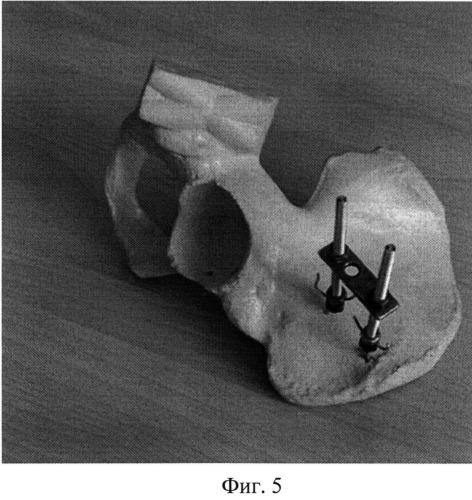 Способ и устройство для фиксации переломов и перемещения плоских костей (варианты) (патент 2519632)