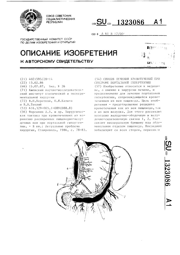 Способ лечения кровотечений при синдроме портальной гипертензии (патент 1323086)