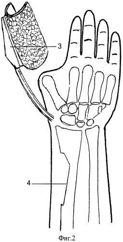 Способ профилактики перелома лучевой кости при пластике "китайским" лоскутом (патент 2506053)