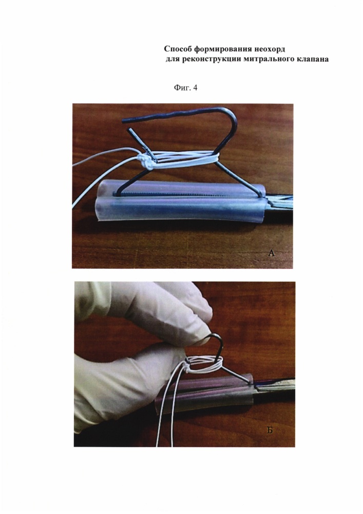 Способ формирования неохорд для реконструкции митрального клапана (патент 2629613)
