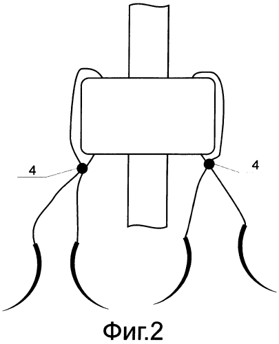 Способ имплантации перитонеального катетера (патент 2560906)