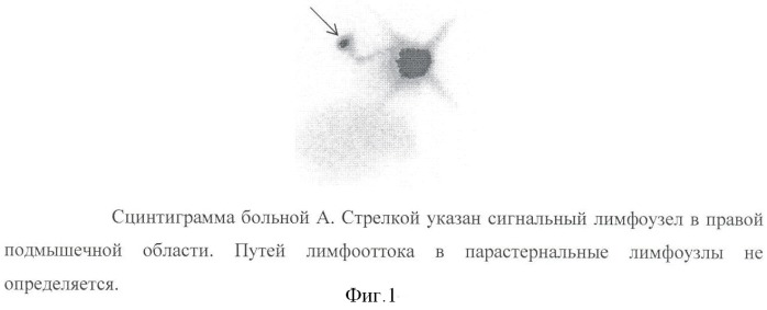 Способ индивидуальной предлучевой подготовки больных раком молочной железы (патент 2377020)