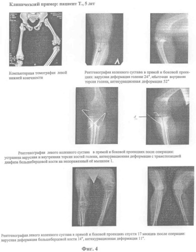 Способ устранения деформации большеберцовой кости у детей (патент 2345723)