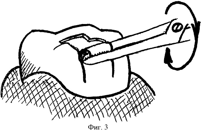 Способ удаления зубных коронок (патент 2392899)