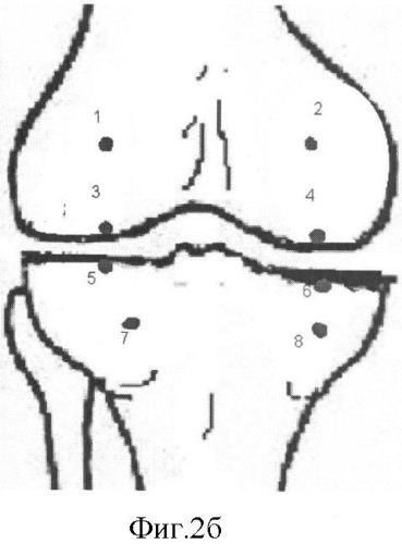 Способ определения степени изменения губчатой кости при деформирующем артрозе коленного сустава (патент 2487669)