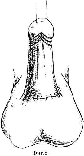 Способ высвобождения кавернозных и спонгиозного тел и удлинения видимой части ствола полового члена (патент 2350284)