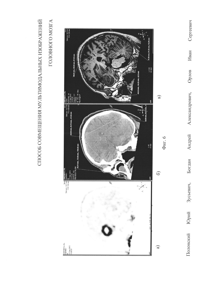 Способ совмещения мультимодальных изображений головного мозга (патент 2607958)