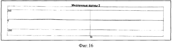 Способ определения типа демпинг-реакции при демпинг-синдроме (патент 2334456)