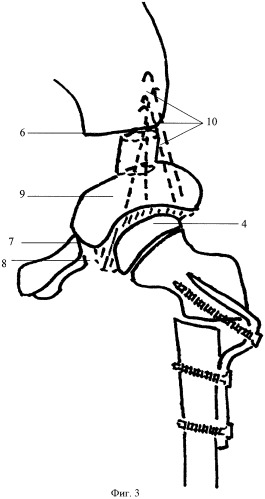 Способ транспозиции вертлужной впадины после тройной остеотомии таза (патент 2414186)