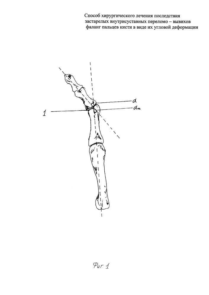 Способ хирургического лечения последствия застарелых внутрисуставных переломо-вывихов фаланг пальцев кисти в виде их угловой деформации (патент 2612588)