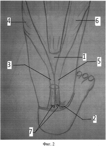 Способ хирургического лечения застарелого разрыва ахиллова сухожилия (патент 2537888)