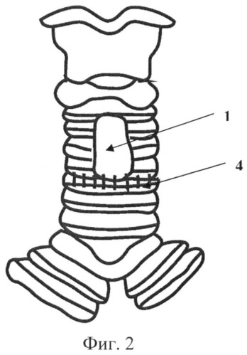 Способ этапного хирургического лечения протяженных и/или мультифокальных стенозов гортани и/или трахеи (патент 2511661)