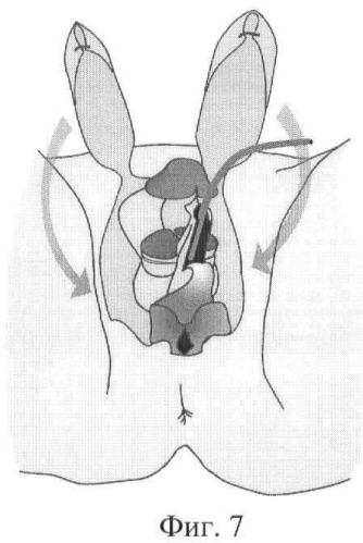 Способ реконструкции наружных женских половых органов при вирилизации наружных половых органов у девочек (патент 2470603)