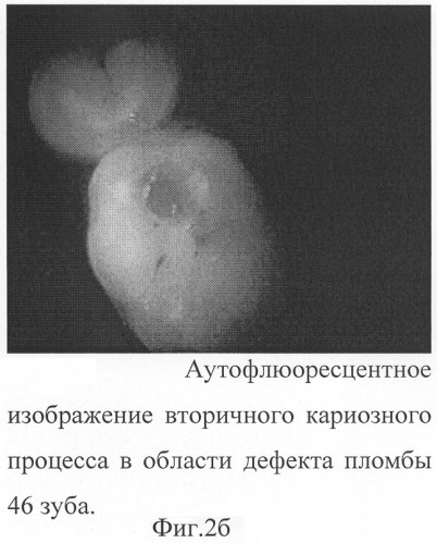 Дентальная флюоресцентная видеокамера (патент 2286081)