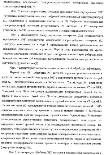 Способ неинвазивного электрофизиологического исследования сердца (патент 2417051)