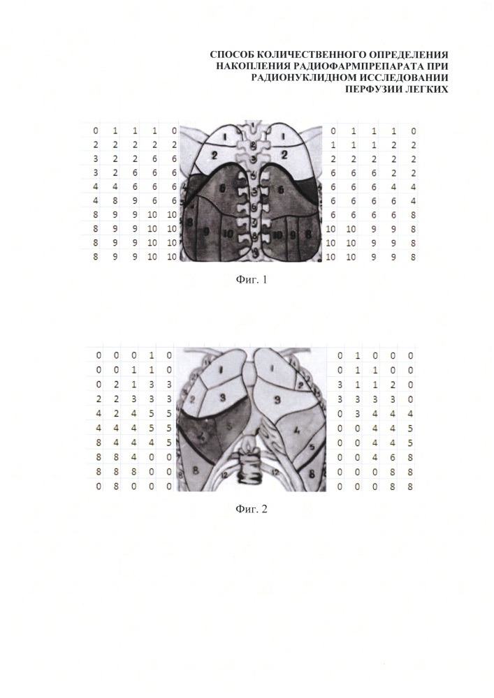 Способ количественного определения накопления радиофармпрепарата при радионуклидном исследовании перфузии легких (патент 2629044)