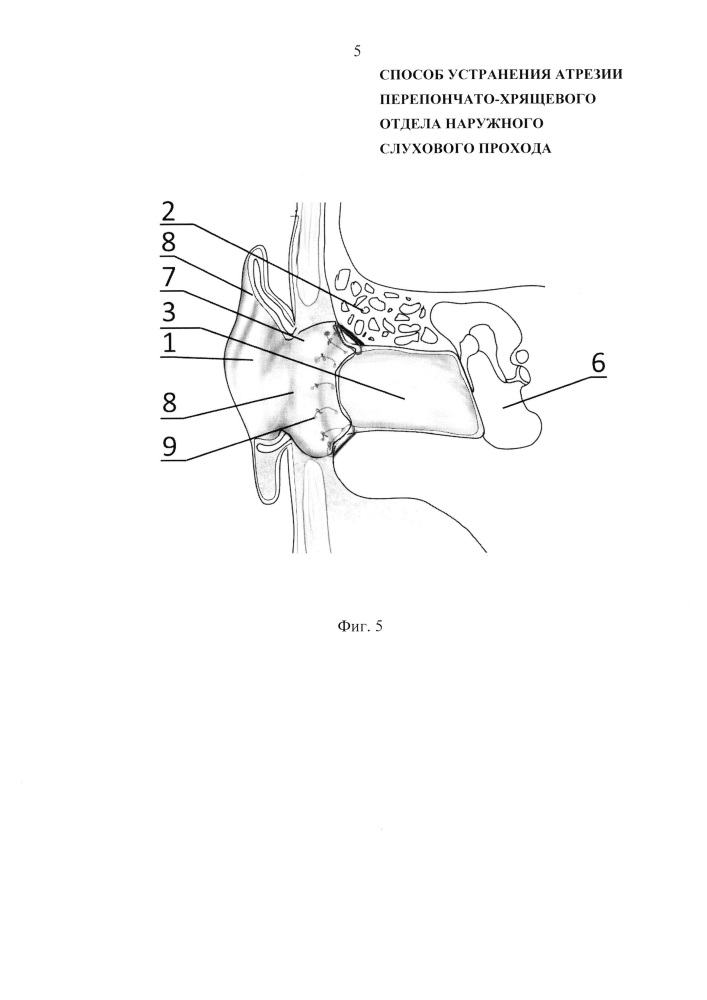Способ устранения атрезии перепончато-хрящевого отдела наружного слухового прохода (патент 2621948)