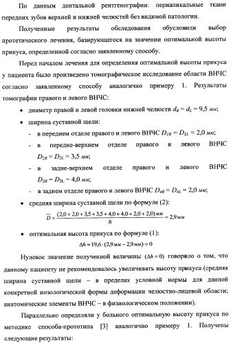 Способ определения оптимальной высоты прикуса (патент 2354300)