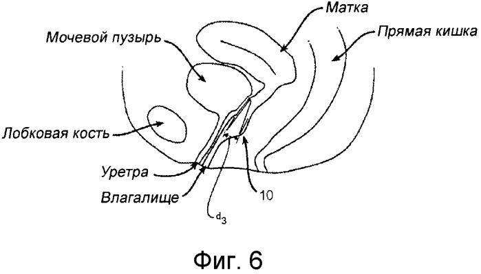 Интравагинальное устройство для лечения недержания мочи (патент 2564078)