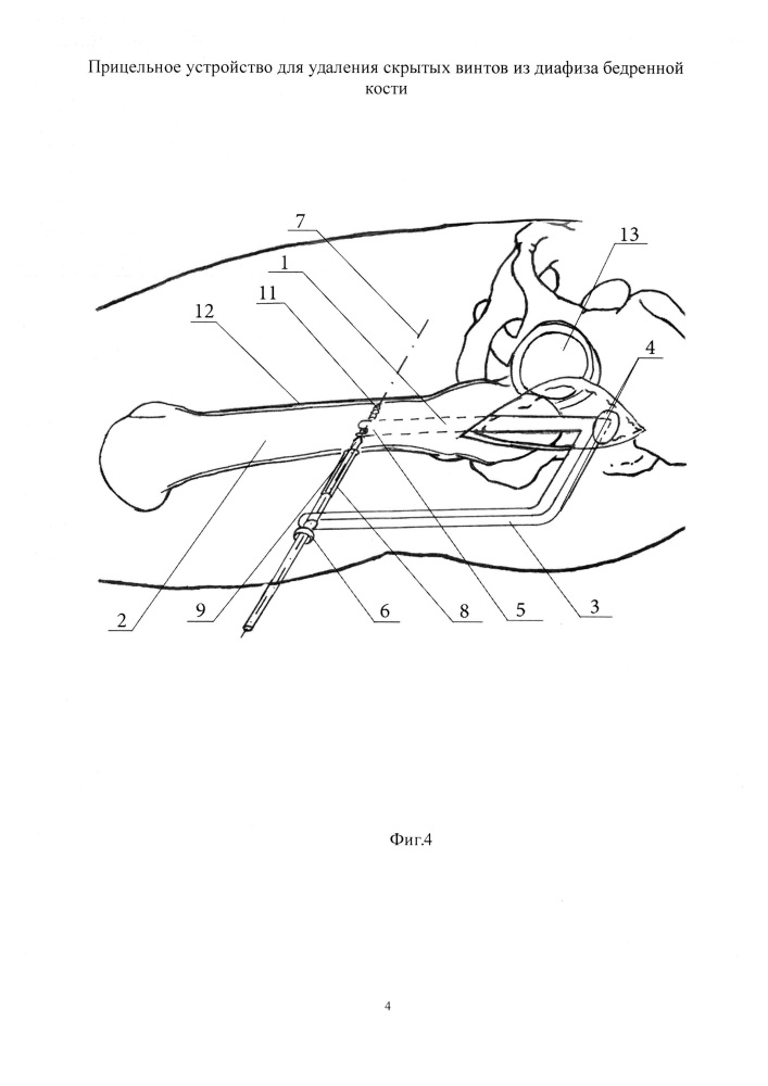 Прицельное устройство для удаления скрытых винтов из диафиза бедренной кости (патент 2614496)