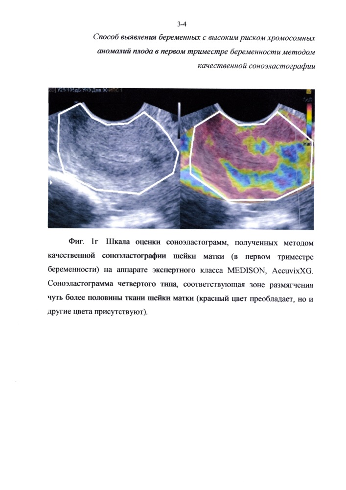 Способ отбора беременных женщин для проведения инвазивной диагностики хромосомных аномалий плода в первом триместре беременности методом качественной соноэластографии (патент 2626144)