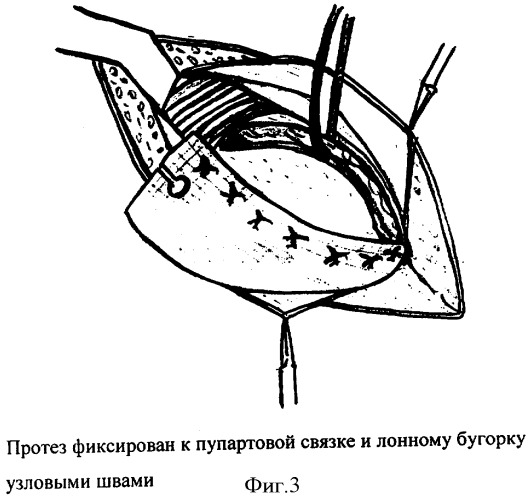 Способ герниопластики при паховых грыжах (патент 2338467)